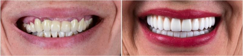 teeth veneers before and after picture