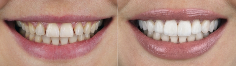 veneer teeth before and after image