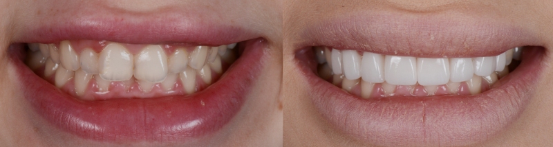 porcelain veneer before and after picture results