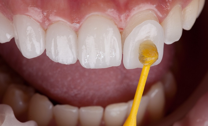 Cost of Teeth Veneers in India: What You Need to Know?