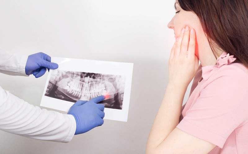 When Do Wisdom Teeth Coming In? 