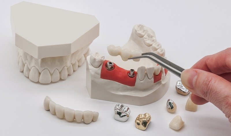Zirconia Dental Implants vs Titanium Implants: Which is Better for Your Smile?