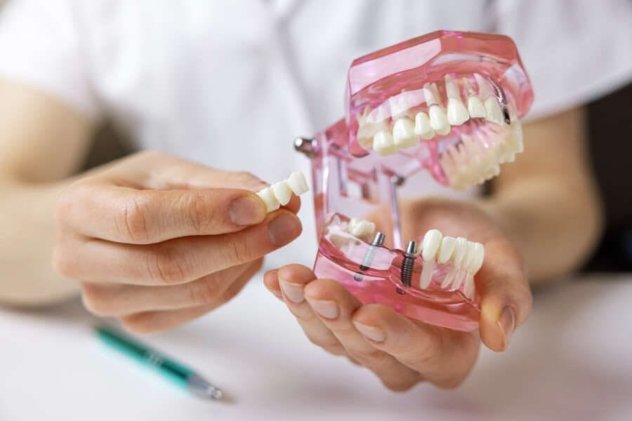 Tooth bridge vs implant: Which one is better?