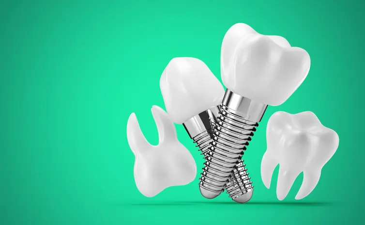 Understanding All-On-4 Dental Implants: Insights from Dr. Stuart Lutton