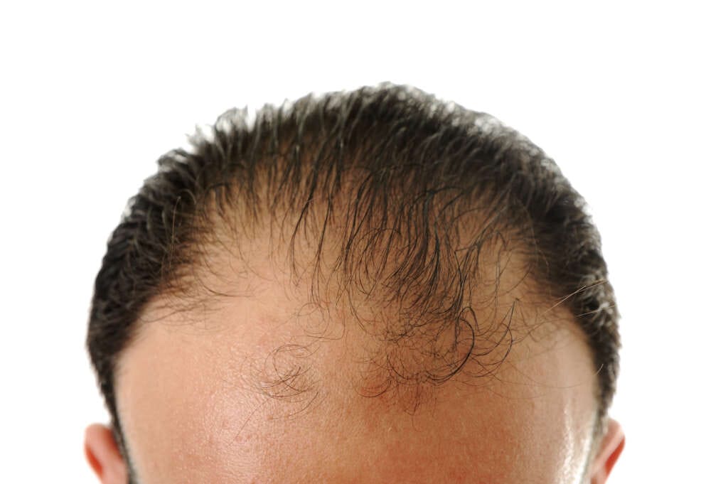Radio presenter and host, Paul Coyte, reveals he’s had a hair transplant