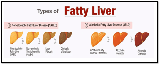 2 types of fatty liver